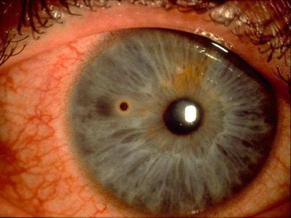 Ophthalmology consult to rule out ocular involvement Corneal Foreign Body Foreign Bodies Speck on cornea or conjunctiva May be inside eyelid need to