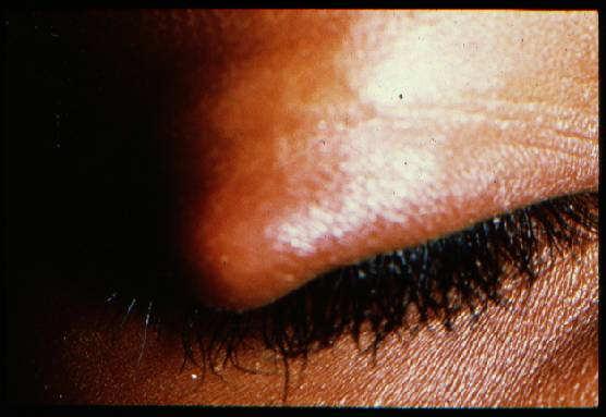Primary Symptom: Swelling Chalazion and Hordeolum Blepharitis (already discussed) Chalazion or hordeolum Preseptal cellulitis Orbital cellulitis Proptosis Chalazion and Hordeolum Clinical