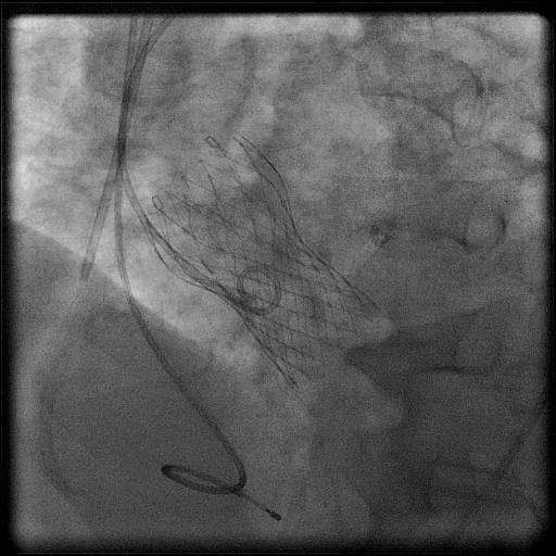 Aortic angiography after CoreValve implantation Fife