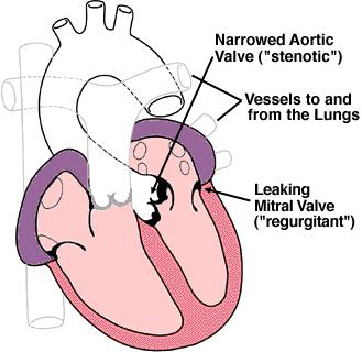Percutaneous Valve Repair Don Bobo Vice President and General Manager Percutaneous Valve Interventions - Repair Anatomy of Mitral Valve Disease ~2M patients (US) have an existing diagnosis of mitral