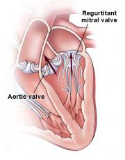 Functional Mitral Valve Disease Regurgitant mitral valve MR caused by ischemic disease
