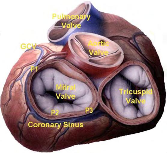 MR Majority of patients are not treated with surgery Coronary Sinus and Mitral Valve