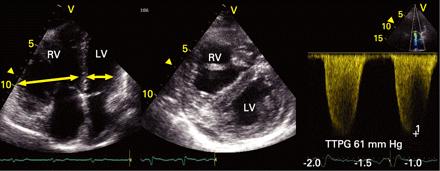 Pulmonary Embolism TTE findings Acute Chest Pain: other causes Cardiac Tamponade accumulation of fluid in the pericardial space that increases intrapericardiac pressure above intracavitary pressure.