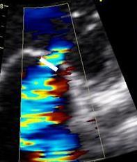 PRF) Eccentric jets Loading conditions Left atrial size
