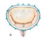 Surgical treatment Mitral valve annuloplasty preferably: probably better outcome preservation mitral (sub) valvular apparatus - maintaining LV geometry