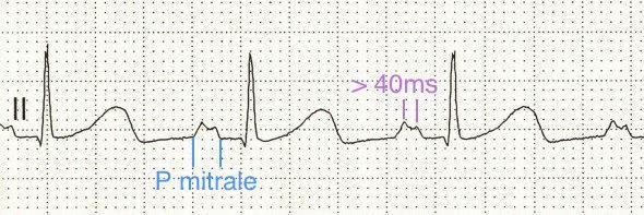 Electrocardiografie Unda P cu aspect mitral