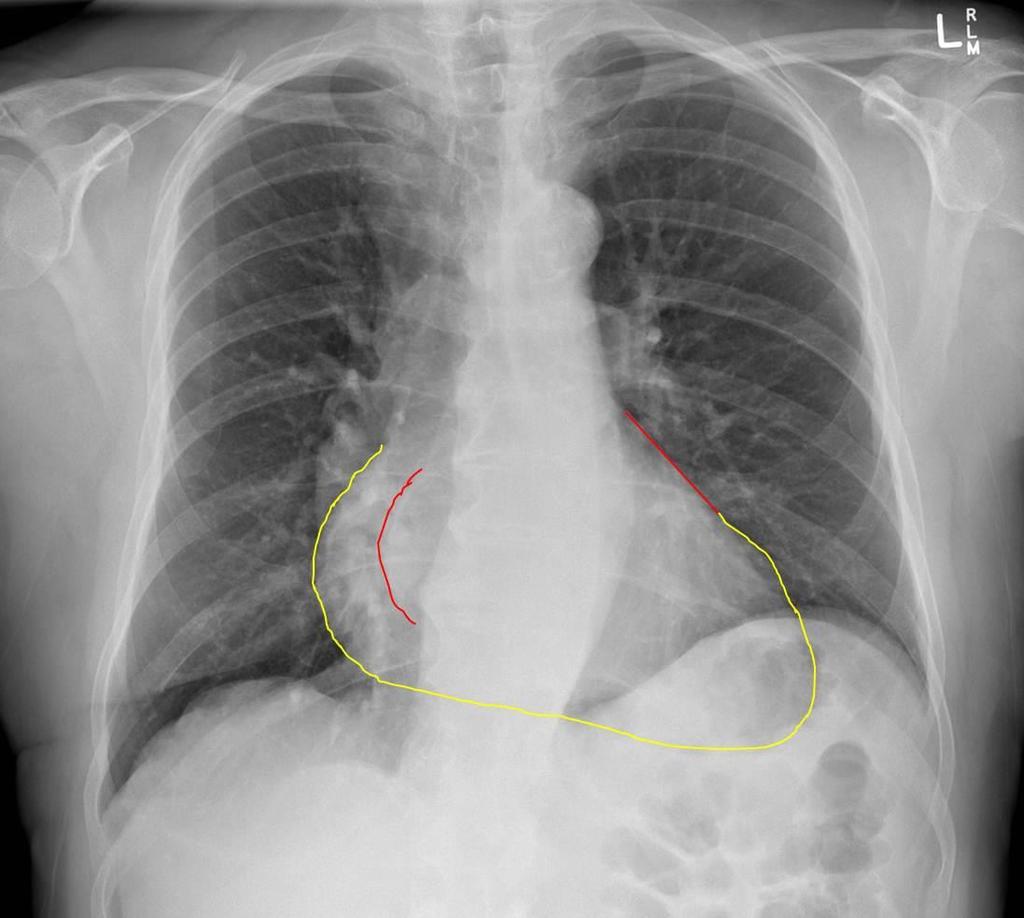 Radiografie cardio-pulmonara Bombarea arcului inferior drept prin