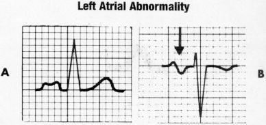Electrocardiograma in RM Dilatare de AS ( unda P bifida) Suprasolicitare de volum VS ( hipervoltaj QRS in