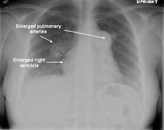 Modalitati de diagnostic in patologia valvei mitrale (2) Radiografia toracica: Frecvent - dilatare de AS (dublu contur la nivelul arcului inferior drept), mai frecvent in