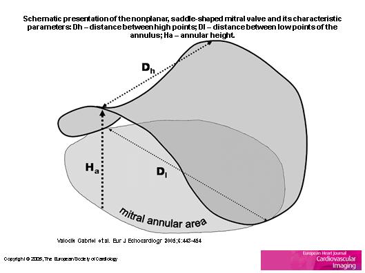 Anatomia Valvei mitrale (2) Non-planeitatea inelului si cuspelor este rationala: baza ventriculului stang scade