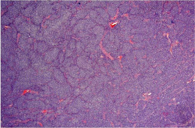 Mimics of neuroendocrine carcinoma Pulmonary