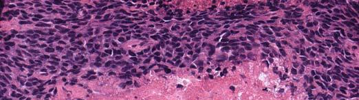 CD56 POSITIVE TUMORS Neuroendocrine tumors Non neuroendocrine tumors High rate (>50%) Non neuroendocrine tumors