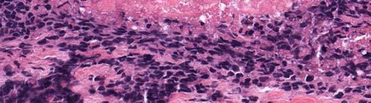 Mesothelioma Small cell carcinoma Desmoplastic round cell tumor Paraganglioma/Pheochromo Synovial sarcoma PNET