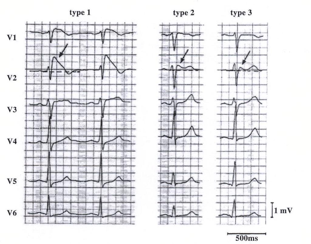 BRUGADA SYNDROME Natural History of Brugada Syndrome Syncope, - ECG