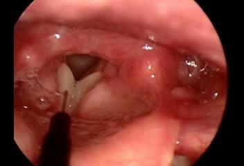 Case 2 Video: female, right tvf paresis,