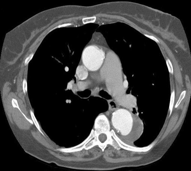 (a) (c) Figure 2 (a) A CT scan of the chest with IV contrast