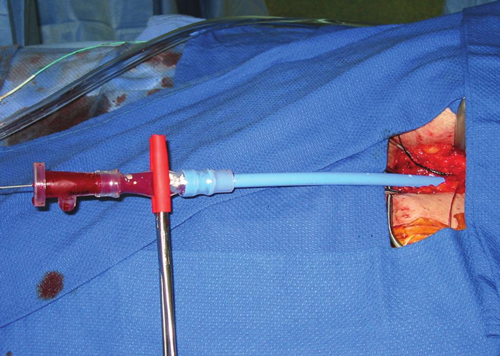 The right 9-F sheath was exchanged for a 22-F Gore sheath and a 34 mm 15 cm TAG stentgraft device was advanced through the Gore sheath (Figure 6).