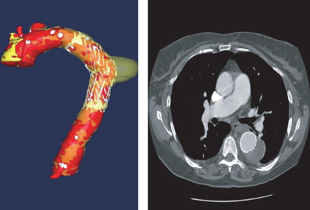 16 SECTION I Thoracic aortic aneurysms (a) (b) Figure 8 (a and b) A CT scan showing successful exclusion of the DTA.