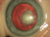 Nuclear Cataract Embryonic or fetal nucleus Often bilateral, dense Microphthalmos