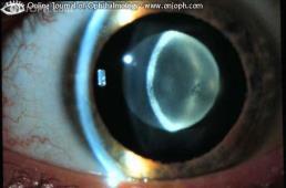 (lamellar) Cataract Zone of the lens Most common is lamellar (inner cortex) Usually