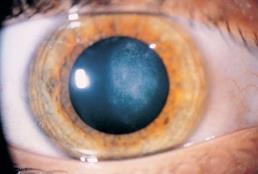 Acquired and bilateral Progressive Secondary causes: Steroids, uveitis, retinal