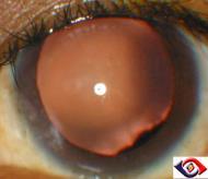 forward causing secondary glaucoma Structural Lens pathology Congenital Aphakia: