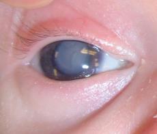 Leukocoria (white reflex) Referring diagnosis Should be seen urgently in amblyogenic age ranges (birth-8 years) Differential diagnosis: Cataract Corneal opacity Peter s anomaly Persistent fetal