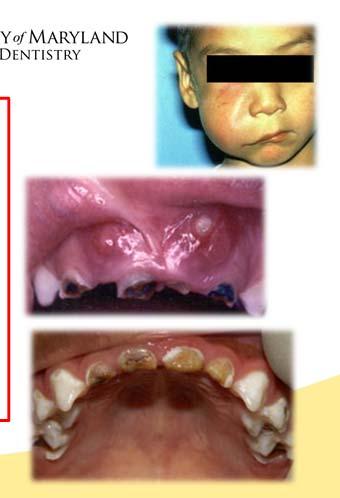 Caries is: Preventable Is the most common childhood illness Continues to affect children in low income communities *Photos from