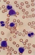 8% Absolute retic number = 40 K/ L CASE # 4 (Peripheral Smear) Anisocytosis 2+ Poikilocytosis 2+ Hypochromia 2+ Microcytosis 2+ Macroovalocytosis 1+ Bizarre-shaped RBCs occasional Tear drops