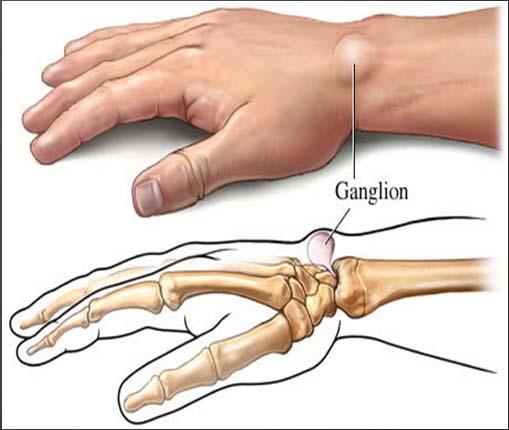 Ganglion cysts Pathology: Leakage of fluid out of the wrist joint or tendon sheath Most common hand