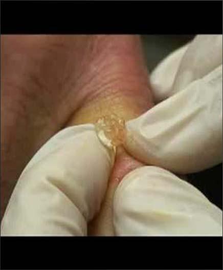 popping the cyst