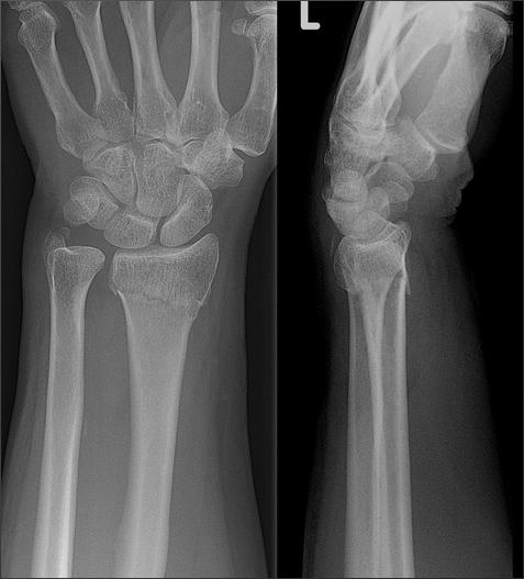 Trauma Any history of TRAUMA necessitates radiographs What to order? 3 VIEWS OF THE WRIST Common fractures include Distal radius fractures Scaphoid fractures Trauma What to do?