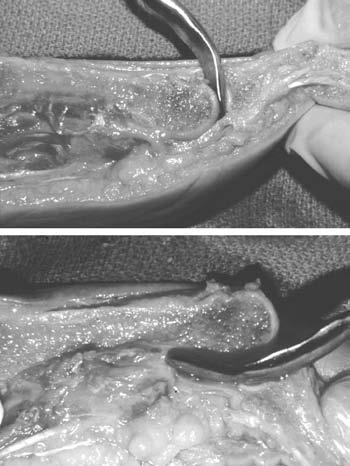 extensor contracture of the lesser MTPJ. After determining an appropriate size, the instrument should easily enter the joint if adequate dorsal capsulotomy had been attempted (Figure 4A).