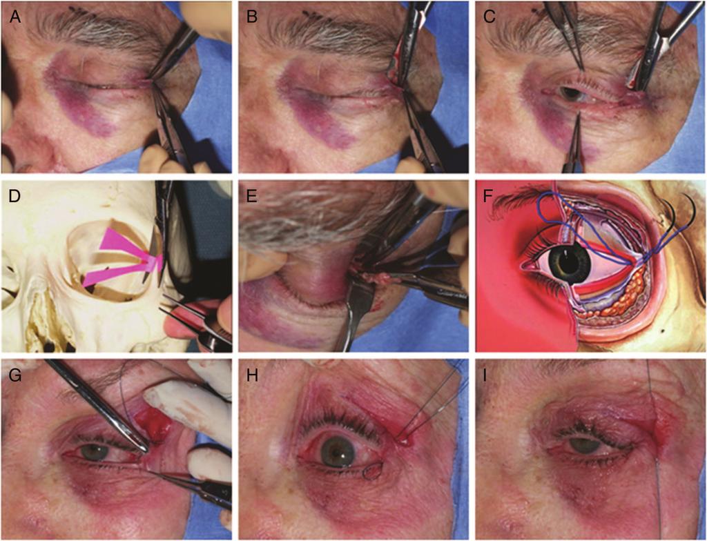 Ophthal Plast Reconstr Surg, Vol. 26, No. 3, 2010 FIG. 1. Intraoperative photograph series demonstrating lateral canthoplasty through a small upper eyelid crease incision.