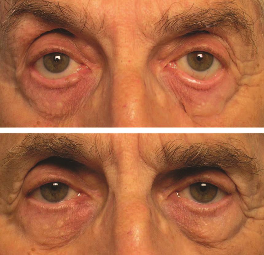 Intraoperative photograph showing the lateral canthoplasty being performed through the lateral aspect of a standard upper blepharoplasty incision (top).