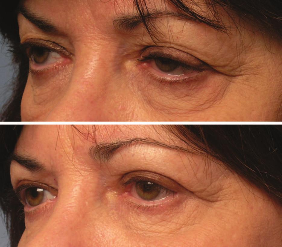 23 This produces lower eyelid laxity, descent of the lateral canthus, and an inferior migration of the lower eyelid.