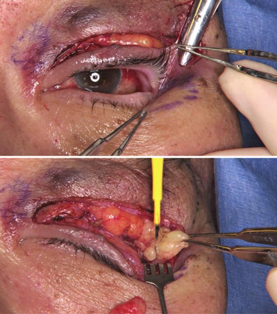 dermal orbicular pennant, the lateral retinacular suspension, transposition of the lateral canthal tendon, and fascial slings to the lower eyelid.