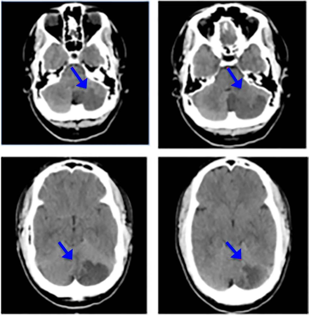 A J VanWagner et al TABLES AND FIGURES Figure 1: CT Demonstrating an Acute Left Cerebellar Infarct in the Distribution of the Posterior