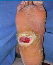 incidence 1% to 4% 1-2 Lifetime risk 15% to 25% 3-4 ~15% of diabetic foot ulcers result in lower extremity amputation 3,5