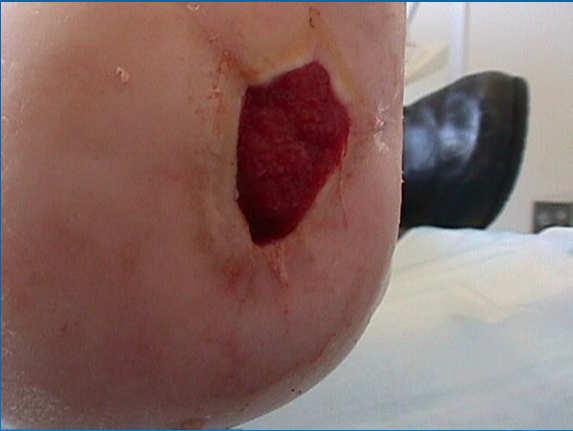 persistence of Apligraf cells on the wound and the safety of this device in