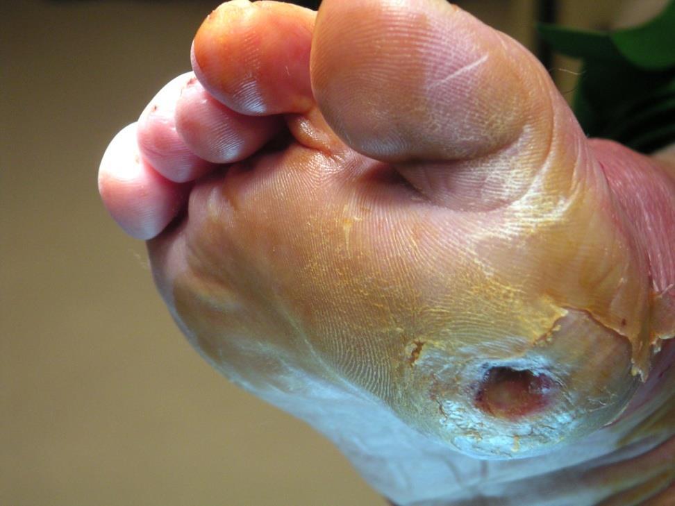Epidemiology of the Diabetic Foot A lower extremity ulcer develops in about 15% of patients with diabetes during their lifetime.