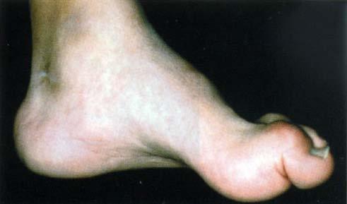 Clawing of the toes Prominent metatarsal