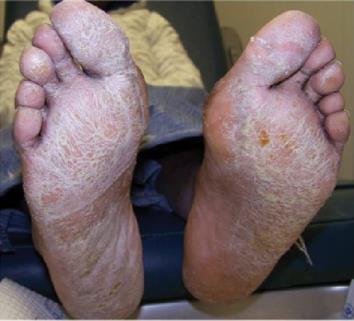 Vuorisalo S et al. Treatment of diabetic foot ulcers. J Cardiovasc Surg 2009;50(3):275-912011;11(5):9-11 2.