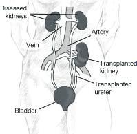 failed kidneys. There are several types of treatment for kidney failure, but transplantation is the only treatment that will work 24 hours a day just like your own kidneys.