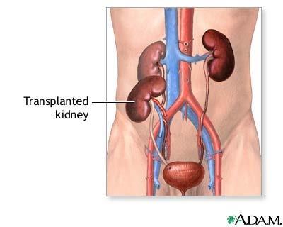 Kidney Transplant Surgery The transplanted kidney is attached to the blood supply Artery Vein