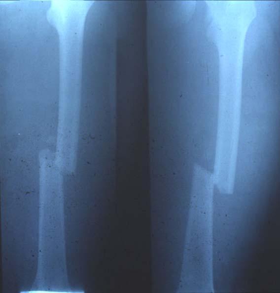 Fracture of the shaft of the femur Mechanisms of