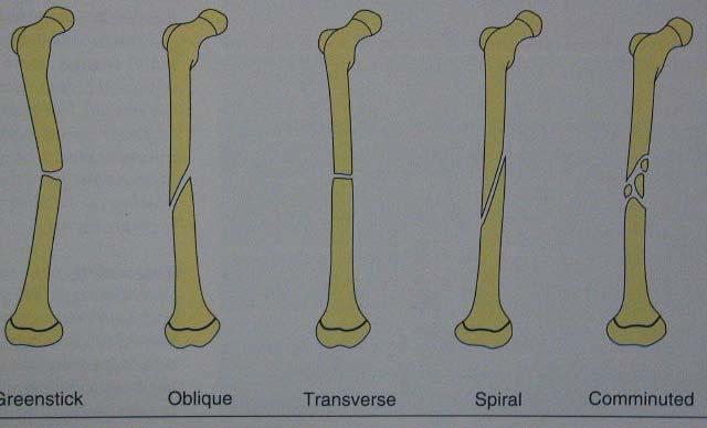 Fracture of the shaft of the femur Type of fractures (according to geometry of Fx