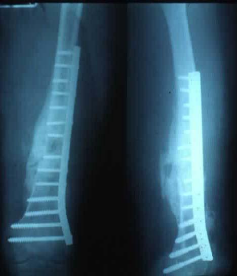 Fracture of the shaft of the femur Treatment