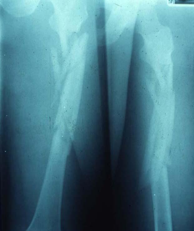 Topics Fracture of the shaft of the femur Fractures around the knee Knee dislocation and fracture