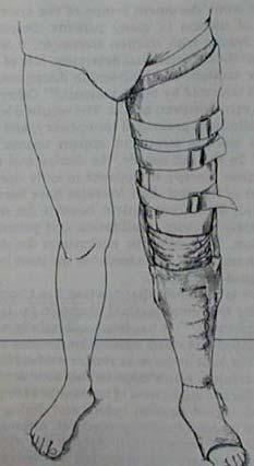Fracture of the shaft of the femur Cast brace Provides external support effect Permits progressive weight